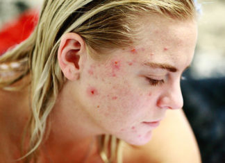 Skóra trądzikowa - kosmetyki, pielęgnacja
