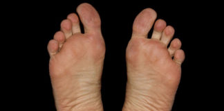 Sposoby na pękające pięty - jak dbać o stopy?
